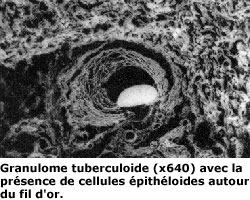 preuve histologique des fils d'or