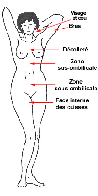 Zones du remaillage